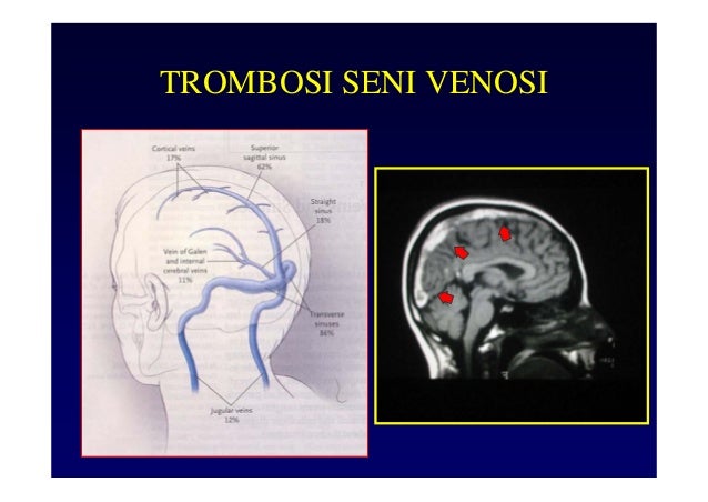Trombosi dopo operazione su emorroidi