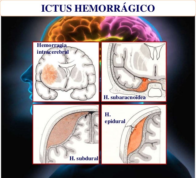 Como calmar los dolores de la osteocondrosis