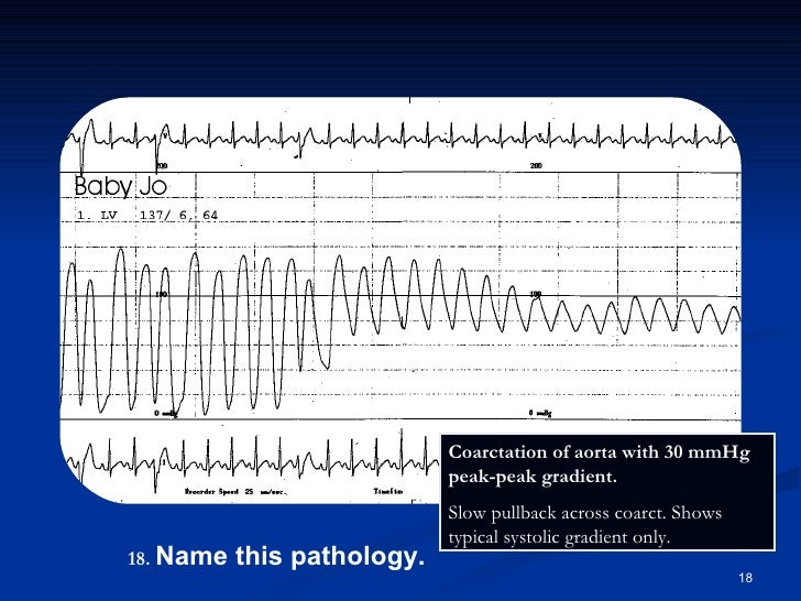 Id Pressure Waveforms