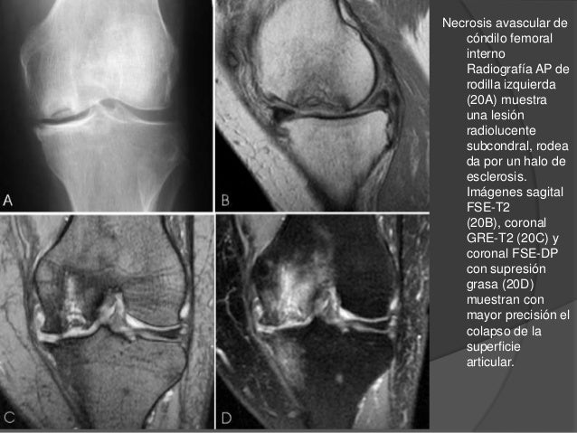 Osteonecrosis de rodilla