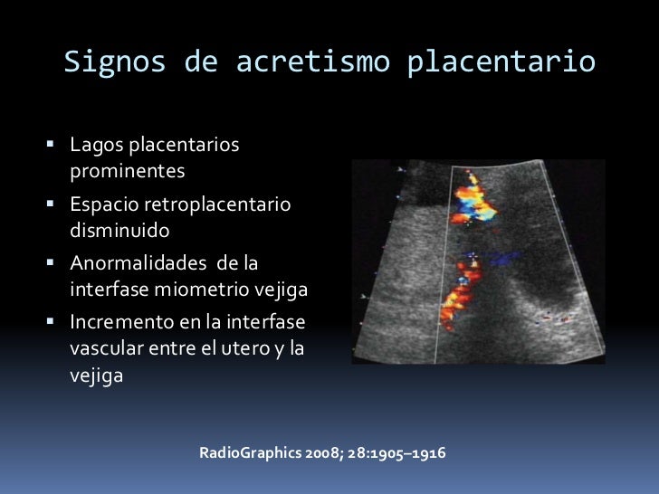 Imagenologia de la placenta acreta.