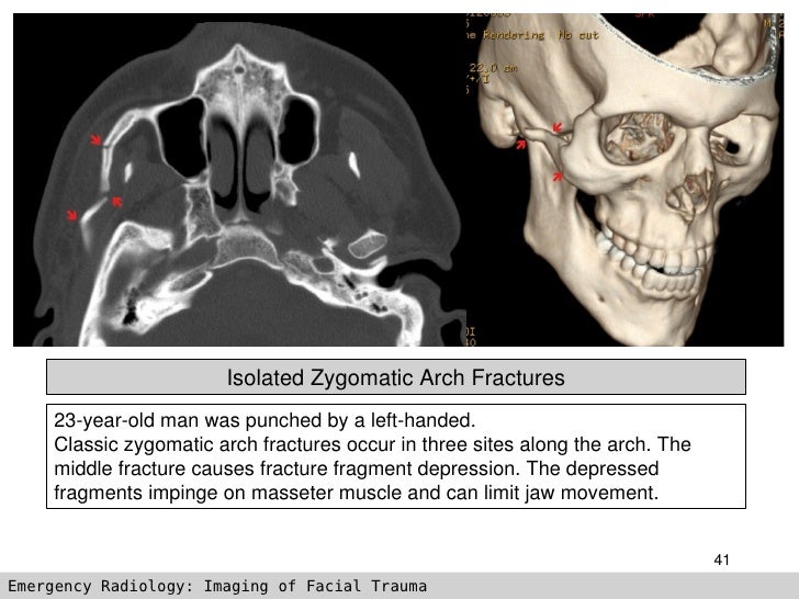 Imaging Of Facial Trauma Part 2