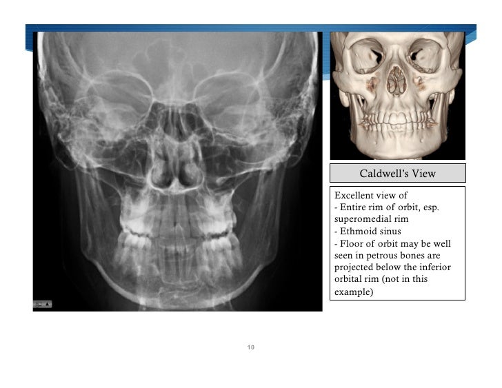 Imaging Of Facial Trauma Part 2