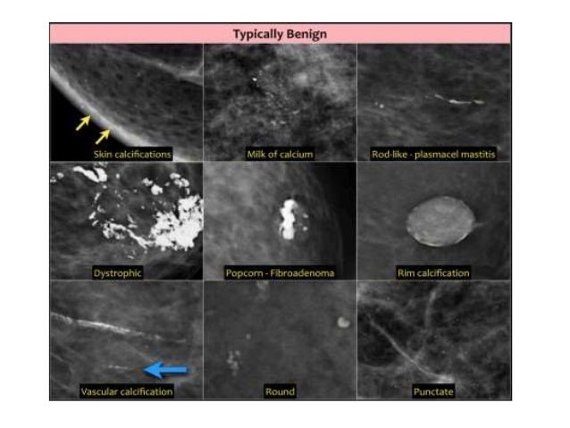 Images of segmental breast calcifications opinion Opinion you images of segmental breast calcifications
