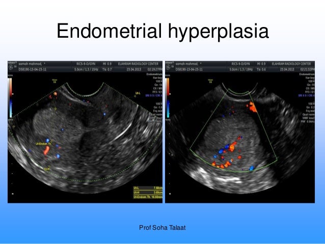 Cervical cancer Ultrasound photos