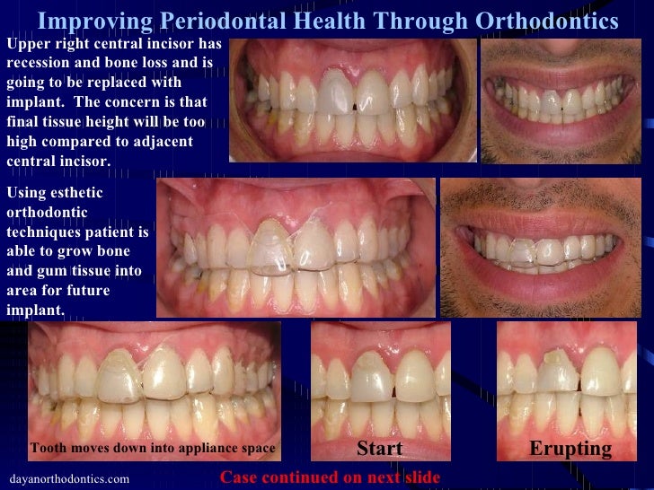 gingival recession