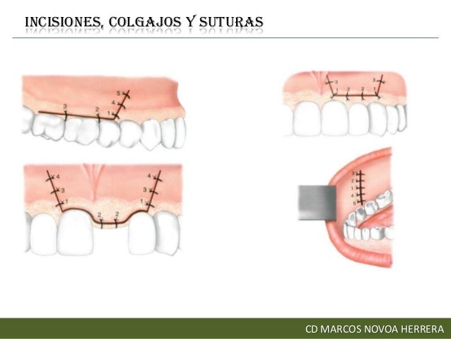 Incisiones, colgajos y suturas