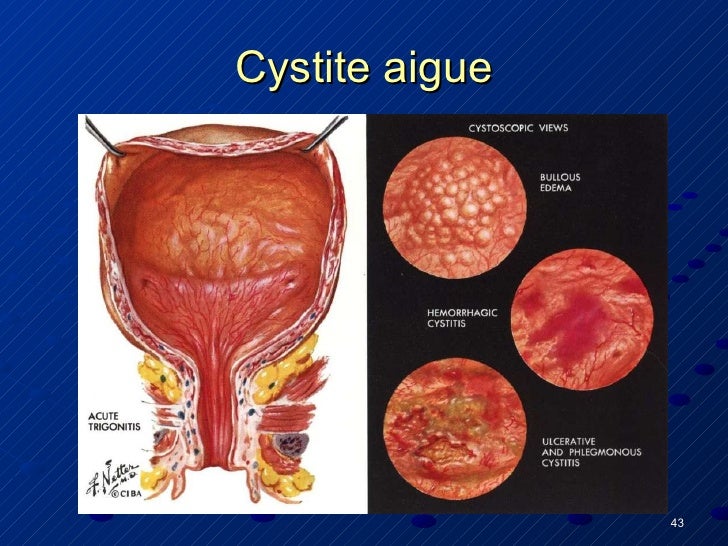 Signe cancer vulve traitement après la chimiothérapie