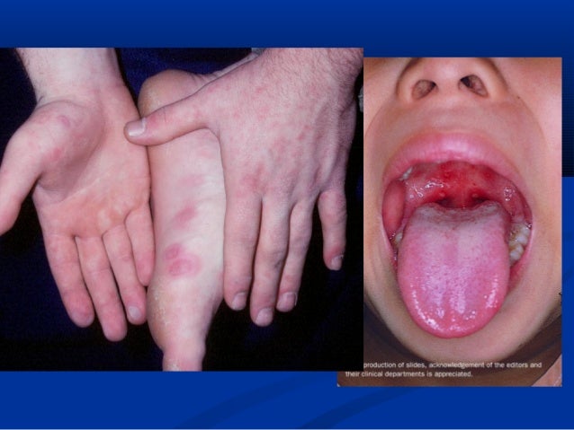 Skin Rash Young Adults Skin Rash Young Adults