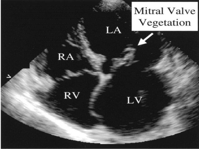 Infective endocarditis