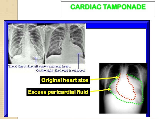 Indocin Dose For Pericarditis