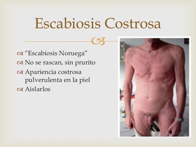 Del sodio tiosulfat las revocaciones de la psoriasis