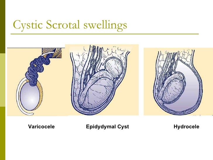 Inguinal And Scrotal Swellings And Scrotal Pain