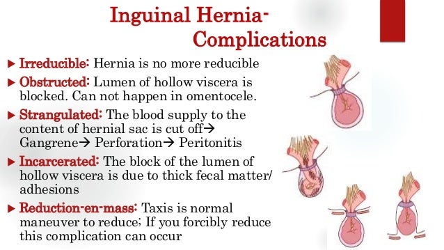 Causes Of Inguinal Hernia Pt Master Guide Images And Photos Finder