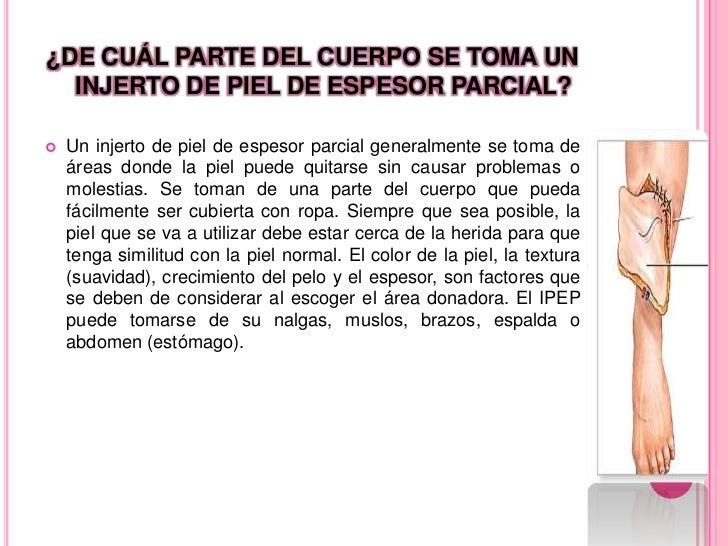 Injertos de piel Injertos de piel