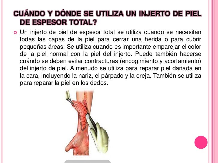 Injertos de piel Injertos de piel