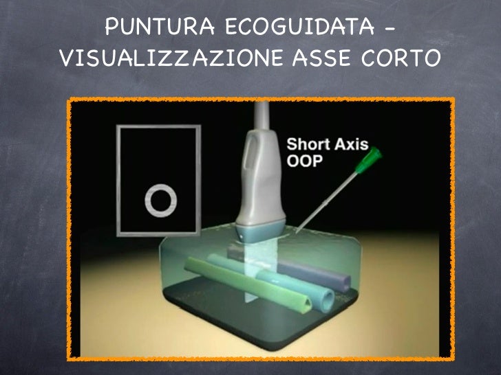 Prevenzione di posizione di asterischi vascolare
