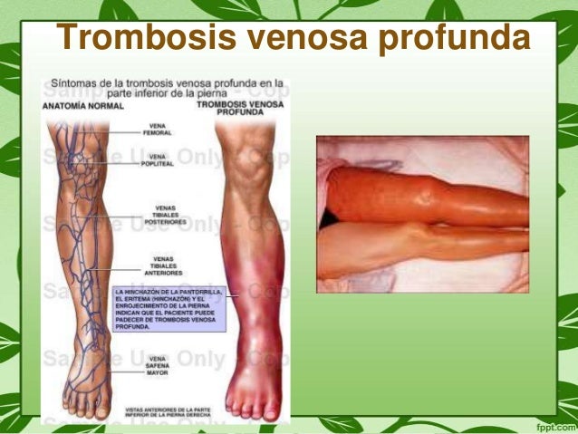 Diferencia Entre Insuficiencia Venosa Y Arterial