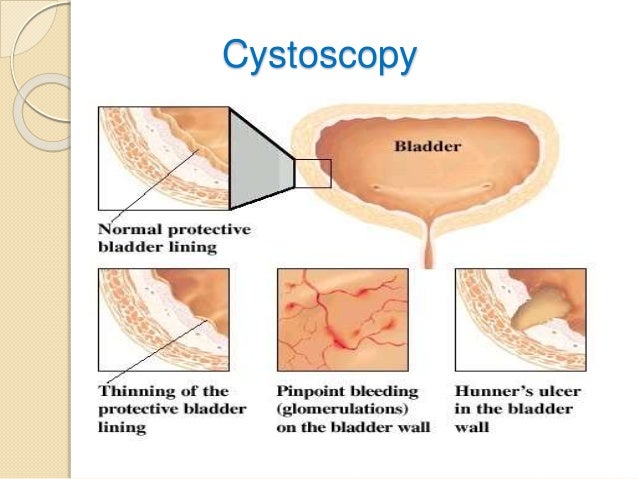 Cervical cancer signs and symptoms analysis