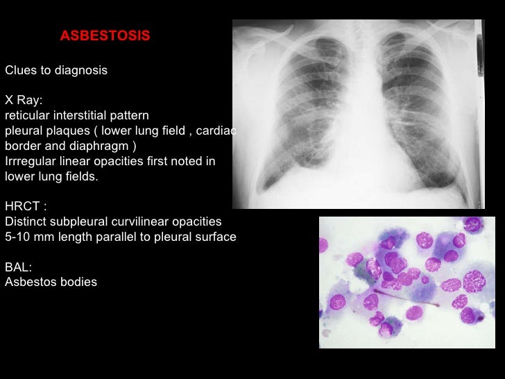 asbestos publicity hotline