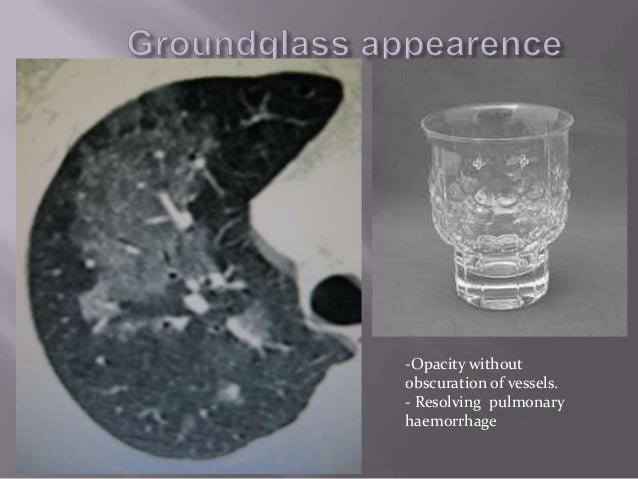 Clinical Diagnosis Asbestosis