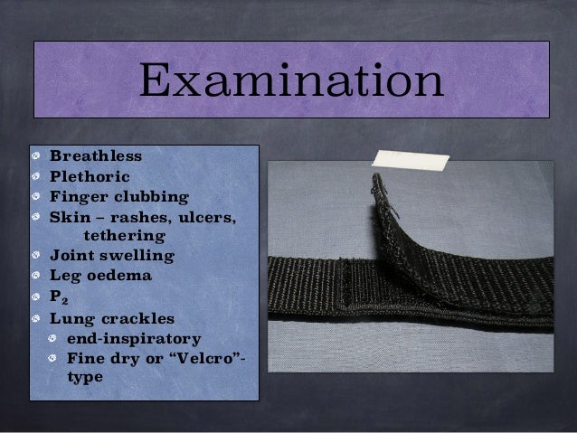 Asbestos related Interstitial Lung disorder Radiology