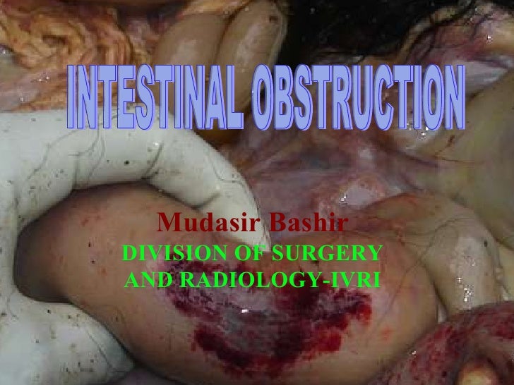 bowel obstruction intestinal obstruction related keywords intestinal obstruction keywords bowel obstruction intestinal obstruction related keywords intestinal obstruction keywords