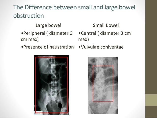 intestinal-obstruction-by-dr-usman-haqqani