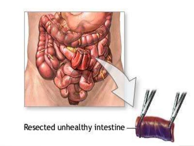 ileus darm