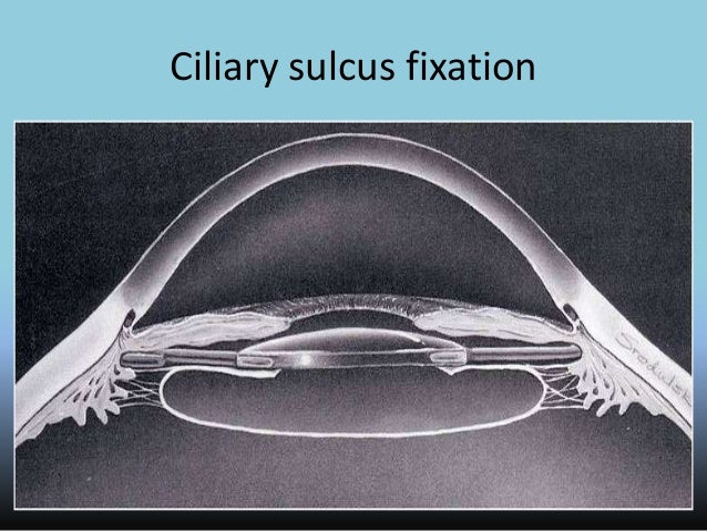 intraocular lens