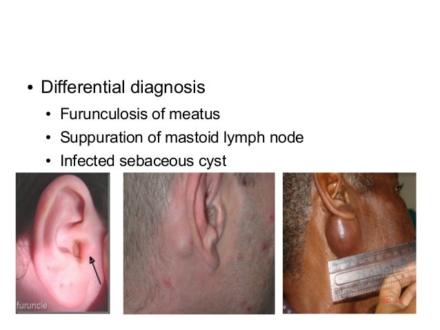 Sinus infection signs treatment
