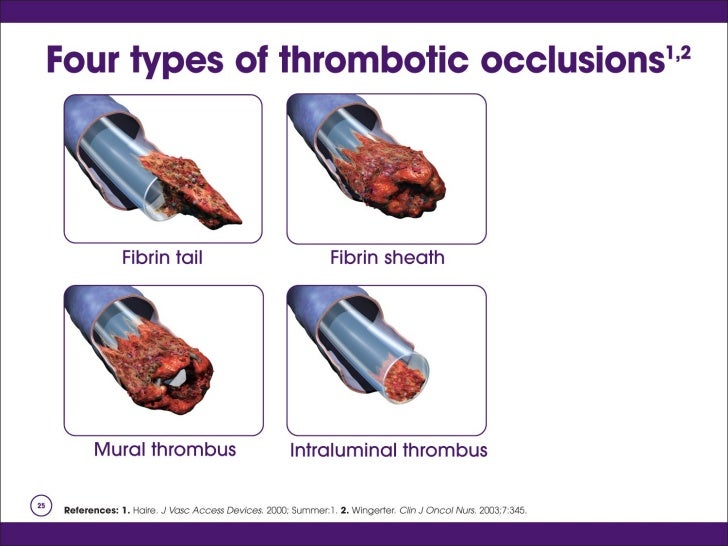 Intra venous therapy complications