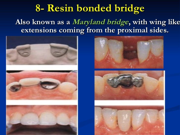 Introduction to fixed prosthodontics