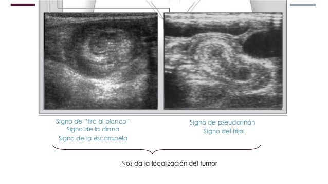 Invaginación intestinal
