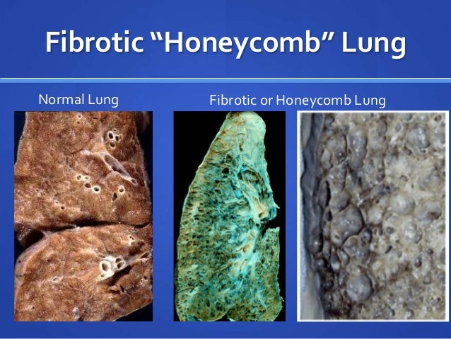 Pulmonay Fibrosis And Viagra