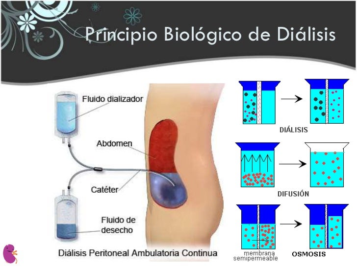 Resultado de imagen de dialisis en la nefrona