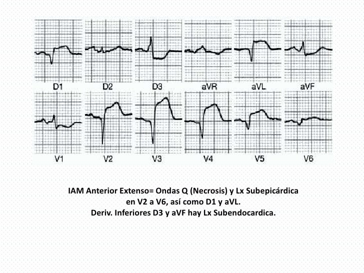 EKG Isquemia