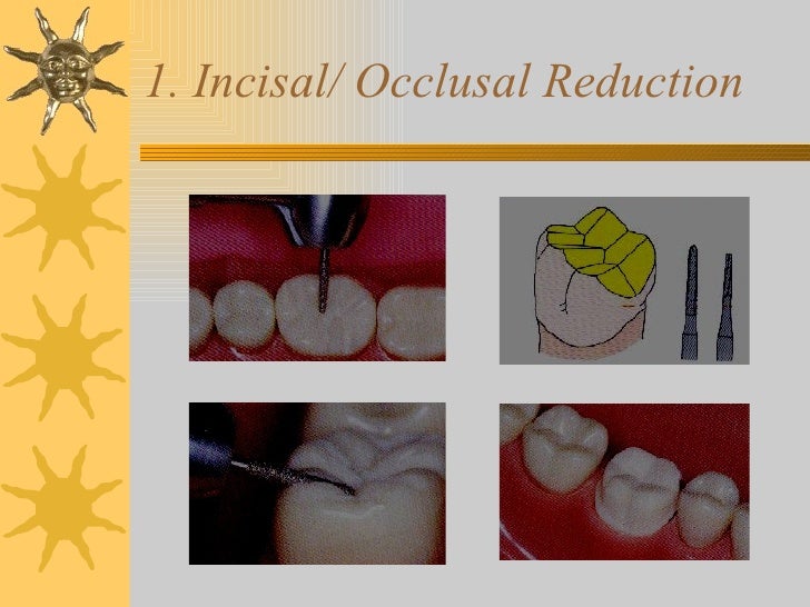 Iv.tooth prep v. occlusion