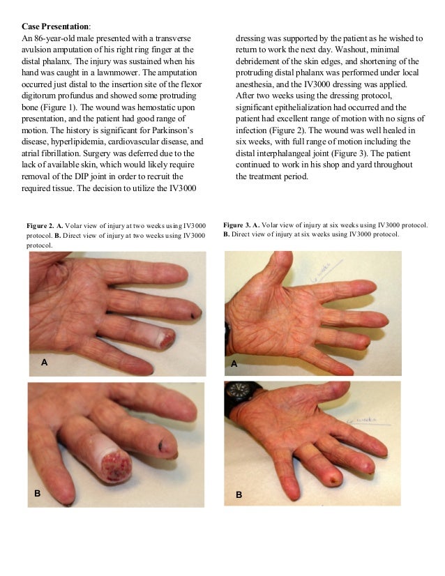 IV 3000 An Innovative Fingertip Dressing