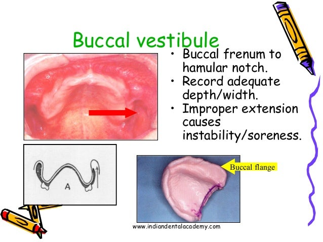 hamular notch