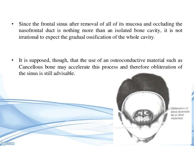 Frontal Sinus Fracture Antibiotics