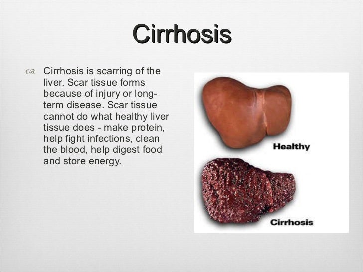 Dangers Of Cirrhosis And Levitra