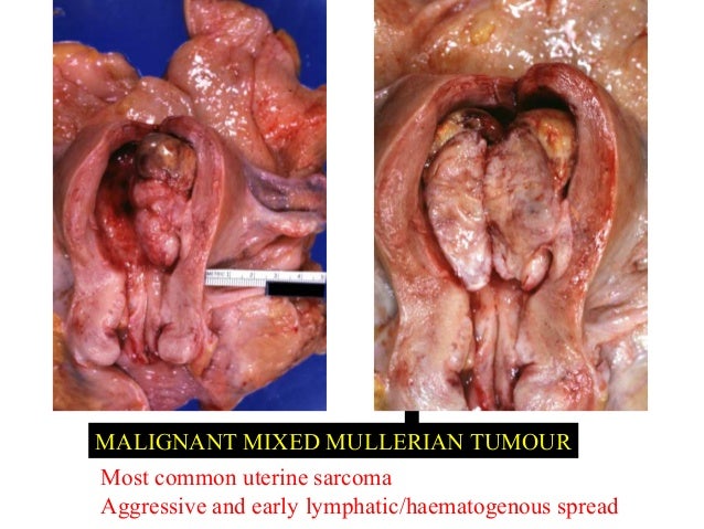 The Stages of Melanoma - SkinCancer.org