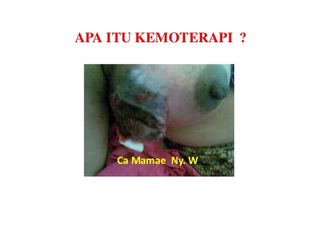 kemoterapi kemoterapi