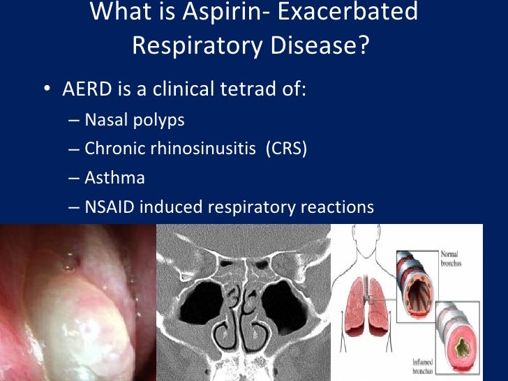AERD Diagnosis and Treatment