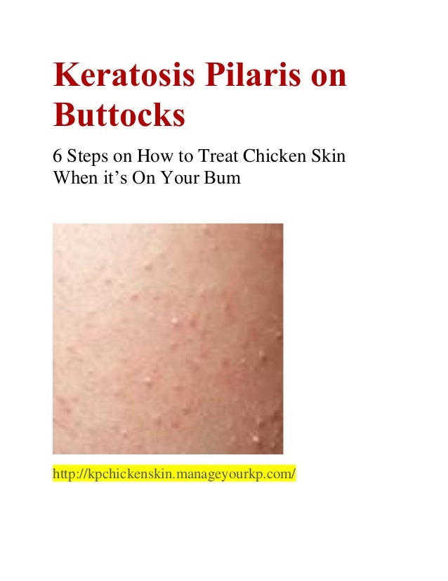Keratosis Pilaris on Buttocks