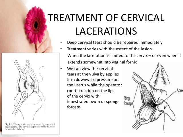 cervical most cancers symptoms opinions