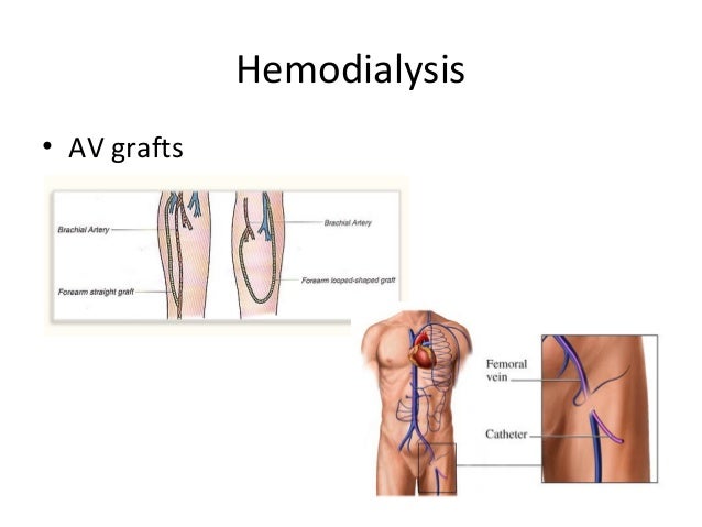 value of kidney dialysis in kerala