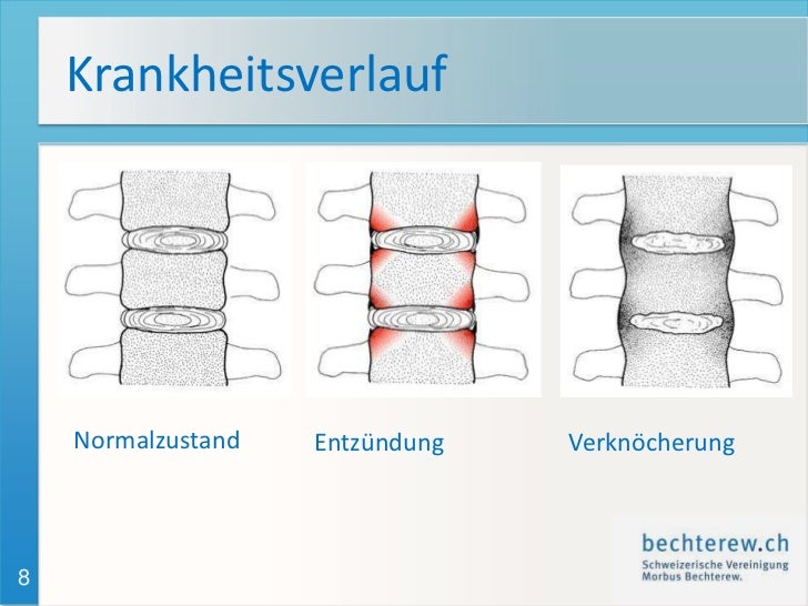 Krankheitsbild Morbus Bechterew