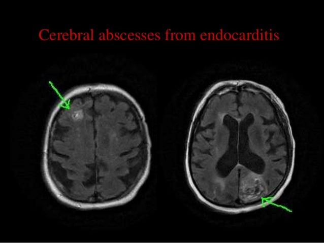Hydrocephalus - Renal Multicystic Dysplasia Hydrocephalus - Renal Multicystic Dysplasia